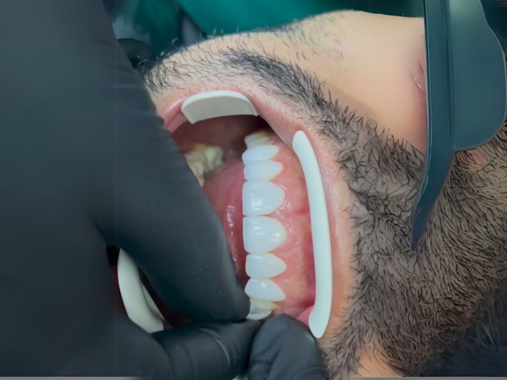 Odontólogo en Caracas colocando laminados cerámicos sin tallar dientes durante diseño de sonrisa