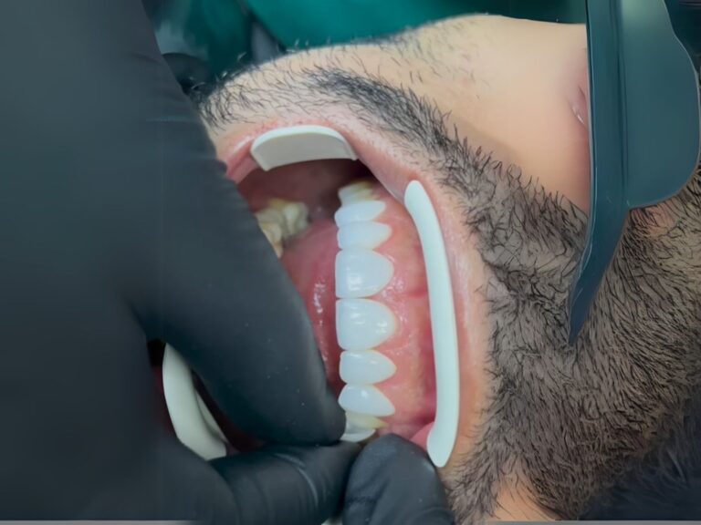 Odontólogo en Caracas colocando laminados cerámicos sin tallar dientes durante diseño de sonrisa