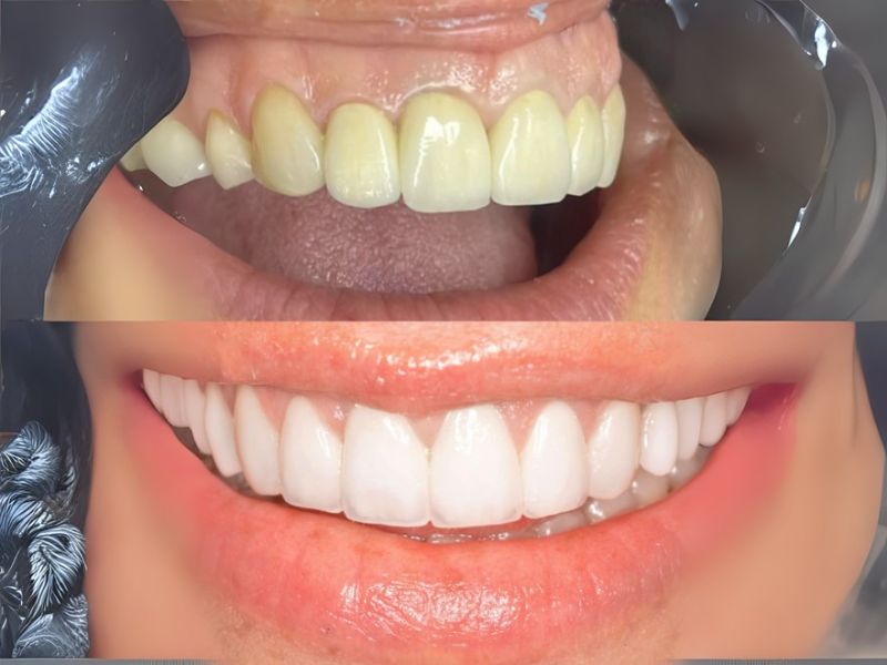 Antes y después de una gingivoplastia realizada por el odontólogo en Caracas Dr. Félix Díaz.