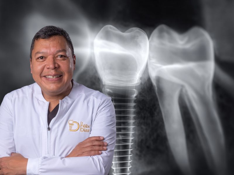 Implantes Dentales en Caracas: ¿Es Posible la Carga Inmediata Después de una Regeneración Ósea?