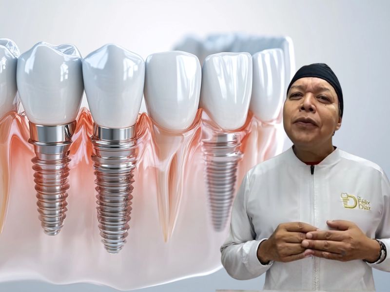 ¿Qué ocurre cuando no hay hueso para implantes dentales?