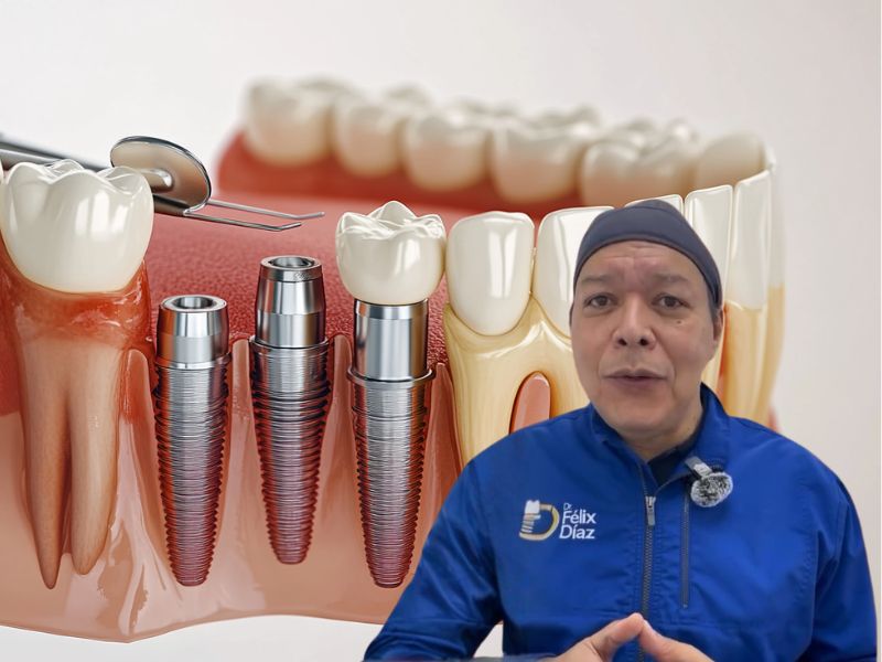 ¿Se puede reparar un implante dental? Caso clínico explicado por el Dr. Félix Díaz